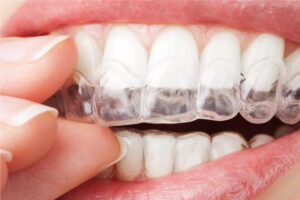 HGC Dental. Blanqueamiento dental con férulas personalizadas.