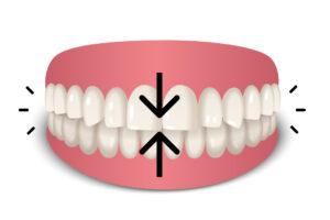 HGC Dental. Tratamiento del bruxismo céntrico en Terrassa.
