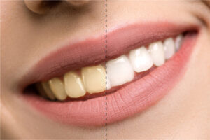 HGC Dental. Servicio de blanqueamiento dental en Terrassa