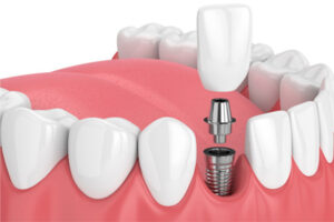 HGC Dental. Implante dental unitario