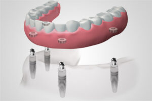 HGC Dental. Implant dental arcada complerta extraible