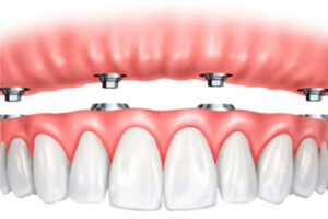 HGC Dental. Implant dental arcada complerta hibrida