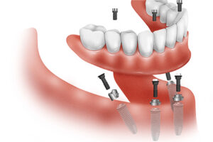 HGC Dental. Implant dental All on four All on six