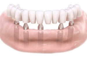 HGC Dental. Implant dental arcada complerta