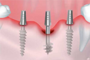 HGC Dental. Implant dental basal