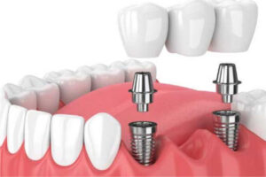 HGC Dental. Implant dental càrrega inmediata