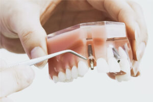 HGC Dental. Servicio de cirugía oral en Terrassa. Implantes dentales